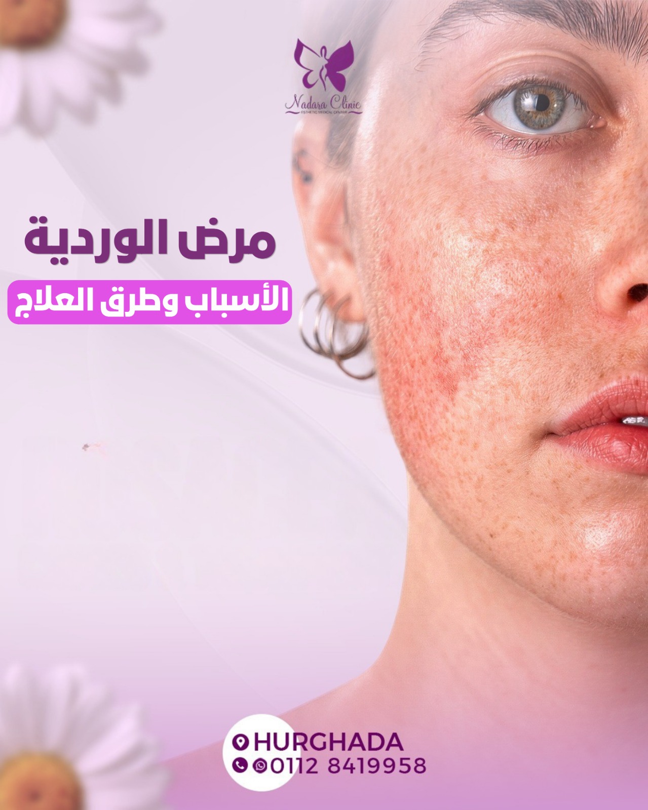 مرض الوردية الأسباب وطرق العلاج في الغردقة
